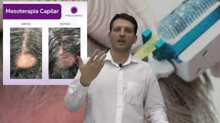 Desvantagens da Mesoterapia Capilar