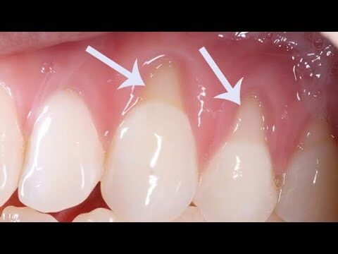 Tratamentos Caseiros para Raiz do Dente Exposta