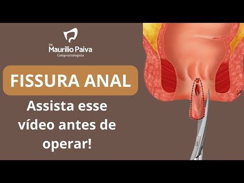 Cirurgia de Fissura: O Que Esperar da Dor