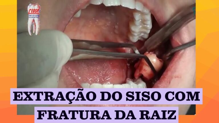 Entendendo a Raiz do Siso: Causas e Tratamentos