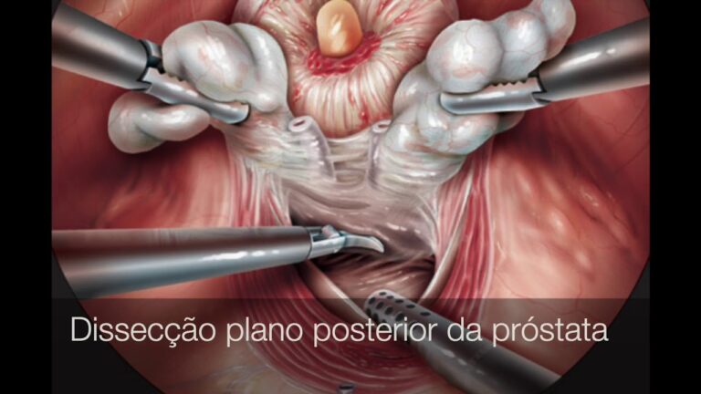 Entendendo a Prostatectomia Total: Indicações e Recuperação