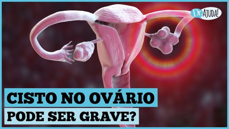 Ovarios com Microcistos: Causas e Tratamentos Eficazes