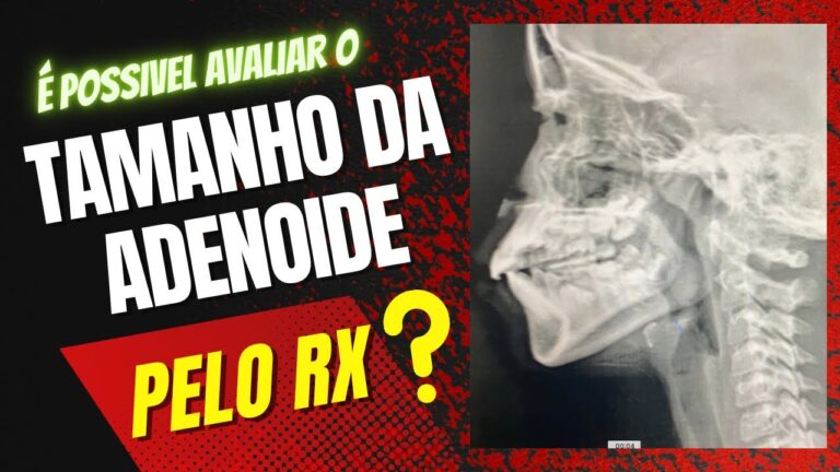 Tratamento Eficaz para RX de Cavum Adenoide