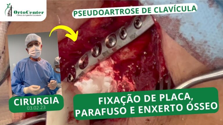 Cirurgia de Clavícula: Benefícios dos Pinos na Recuperação
