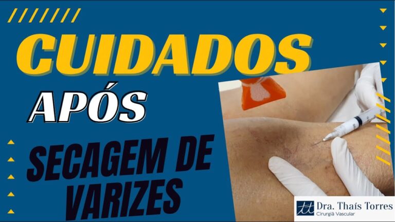 Cuidados Essenciais Ap&oacute;s a Aplica&ccedil;&atilde;o de Varizes