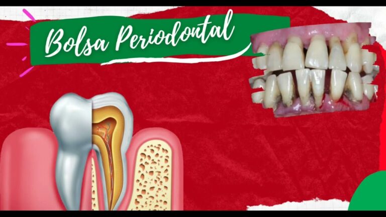 Imagens Reveladoras de Bolsa Periodontal