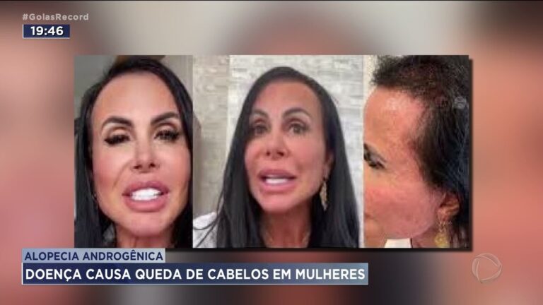 Transforma&ccedil;&otilde;es do Tratamento da Alopecia Androgen&eacute;tica Feminina: Antes e Depois