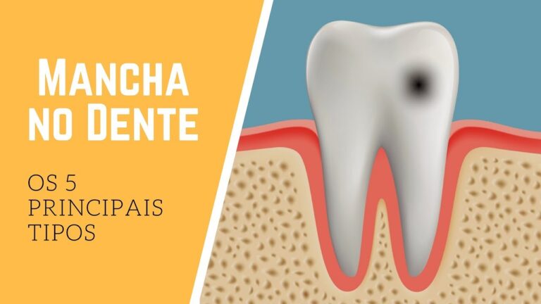 Como Tratar Dentes com Manchas Marrons