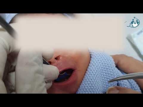Cirurgia da Língua Presa: Benefícios e Cuidados Pós-Operatórios