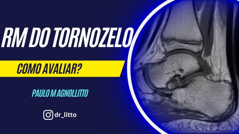 Ressonância Magnética do Tornozelo Esquerdo: Indicações e Benefícios
