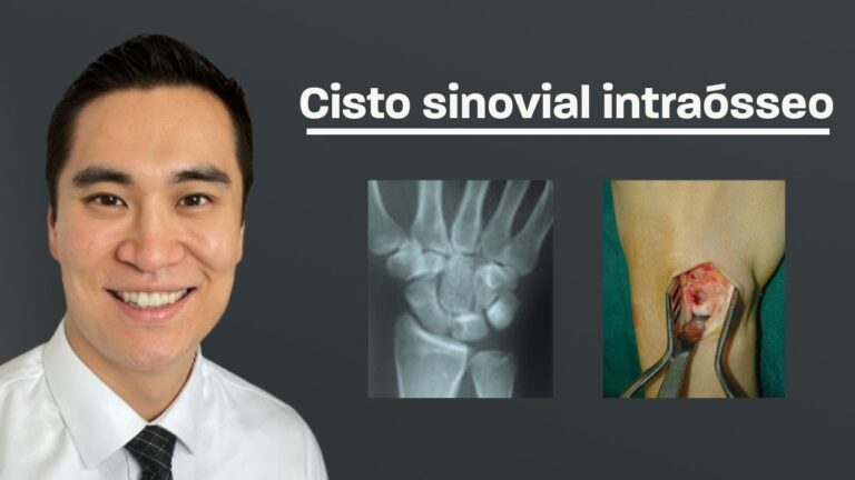 Cisto Artrossinovial Pulso: Causas e Tratamentos Eficazes