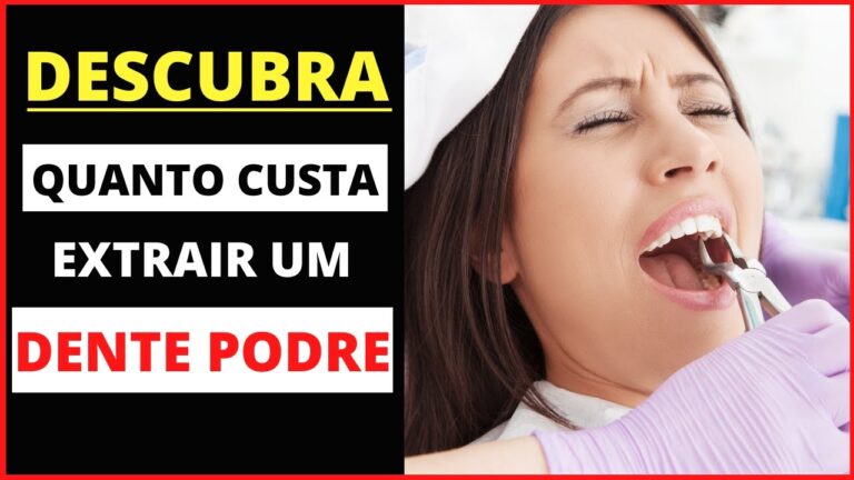 Valores de Extração de Dente: O Que Você Precisa Saber