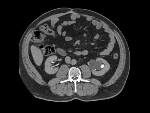 Entendendo o Cisto Parapiélico Renal: Causas e Tratamentos