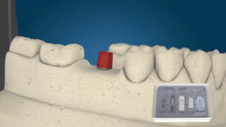 Vantagens da Prótese Dentária Fixa Unitária