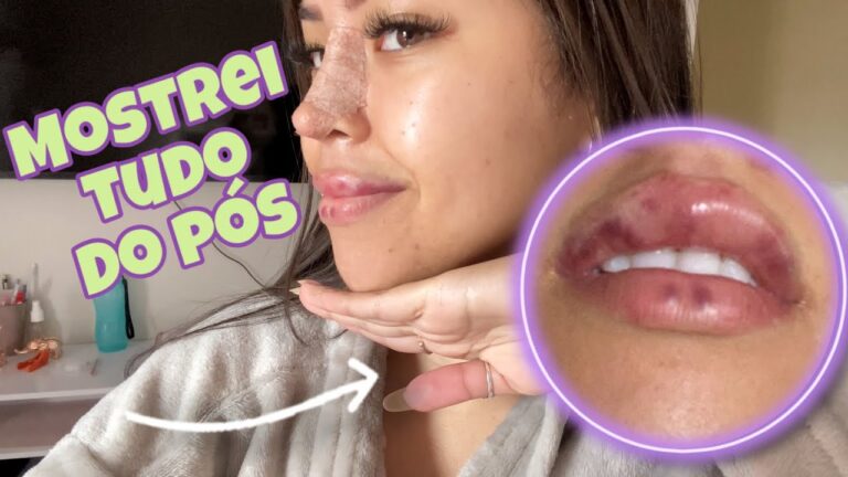 Tempo de Recuperação do Preenchimento Labial: Quantos Dias para Desinchar?