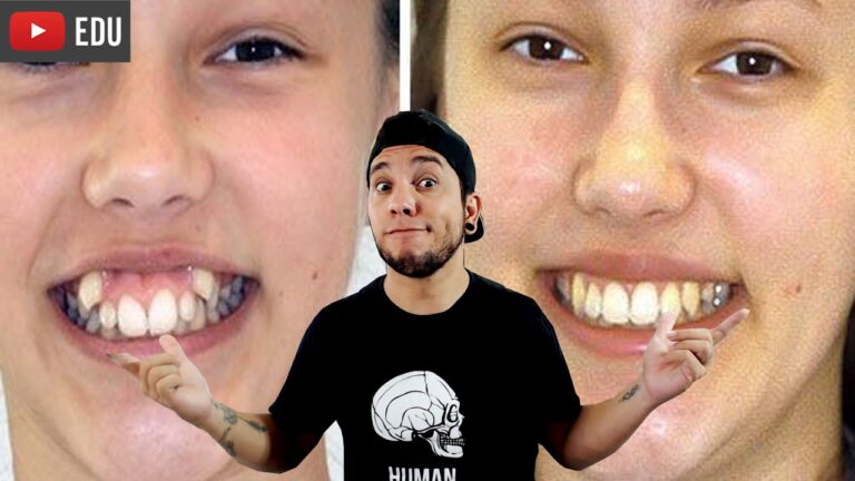 Dente Remontado: Solu&ccedil;&otilde;es e Benef&iacute;cios para a Sa&uacute;de Bucal