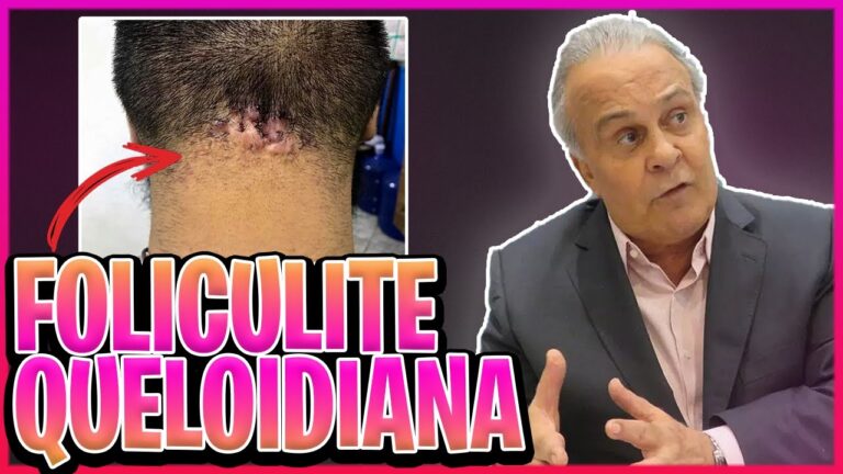 Tratamento Eficaz para Foliculite Queloidiana da Nuca