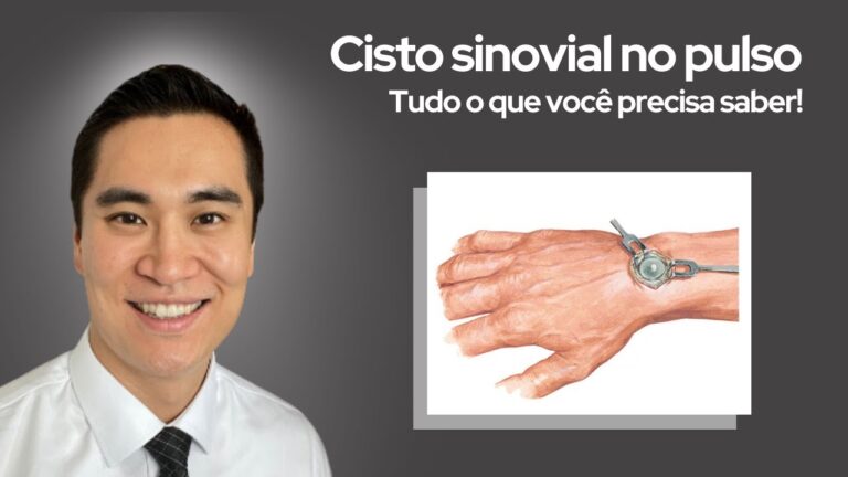 Cisto Sinovial no Mão: Causas, Sintomas e Tratamentos