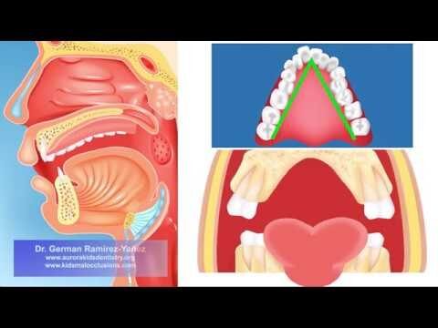 Impactos da Respiração Oral na Saúde Bucal e Geral
