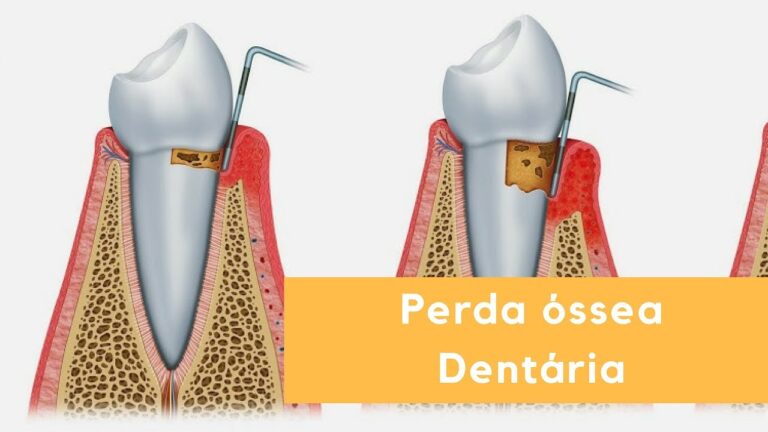 Sintomas da Perda Óssea Dentária: O Que Você Precisa Saber