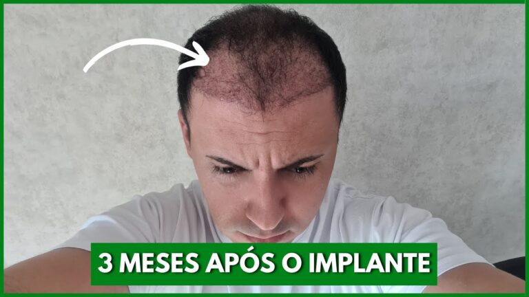 Resultados e Cuidados: 3 Meses Após o Transplante Capilar