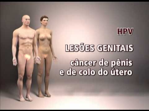 Imagens de HPV em Mulheres: Compreensão e Prevenção