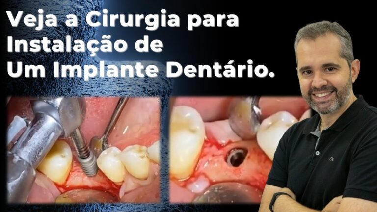 Guia Completo sobre Cirurgia de Implante Dentário