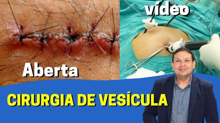 Tamanho do Corte na Cirurgia de Vesícula: O que Esperar