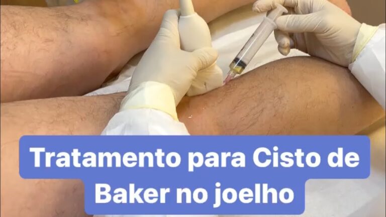 Cisto no Joelho: Quando a Cirurgia é Necessária?