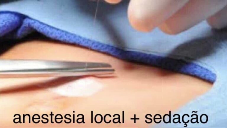 Dura&ccedil;&atilde;o da Cirurgia de H&eacute;rnia Inguinal: O Que Esperar