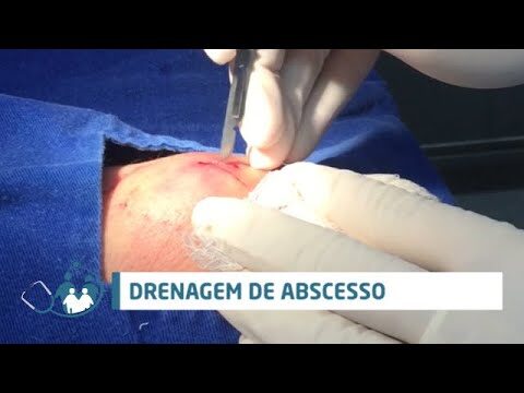 Entendendo o Abcesso no Seio: Causas e Tratamentos