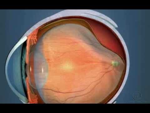 Custo da Cirurgia de Descolamento de Retina: O Que Esperar