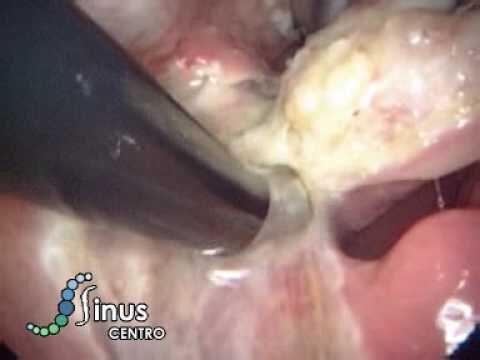 Amigdalectomia: O Que Esperar Antes e Depois do Procedimento
