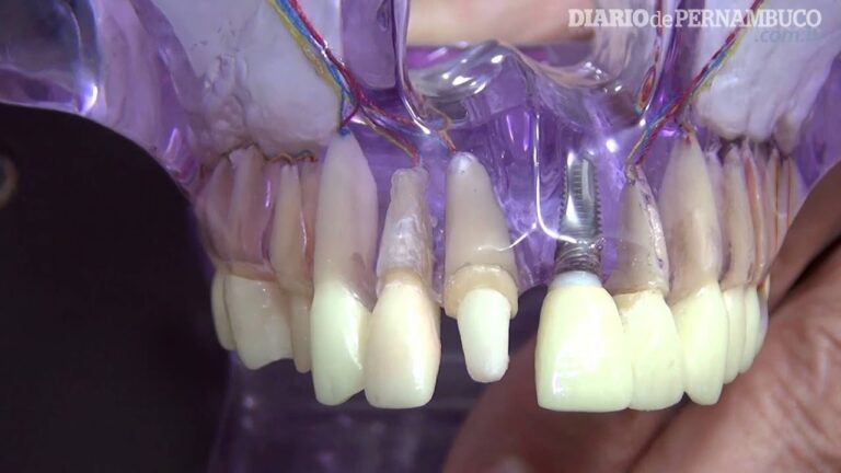 Pivo Dente da Frente: Melhores Práticas e Soluções