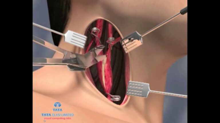 Cirurgia Carotídea: Avanços e Benefícios para a Saúde Vascular
