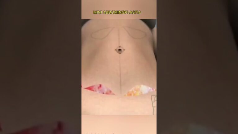 Entendendo a Cirurgia de Abdominoplastia: O Que Esperar