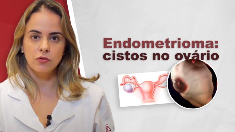 Endometriose e Cisto Ovariano: Causas, Sintomas e Tratamentos