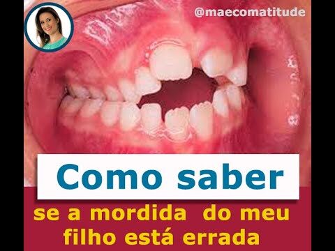 Dentes Tortos: A Influ&ecirc;ncia do H&aacute;bito de Morder o Dedo