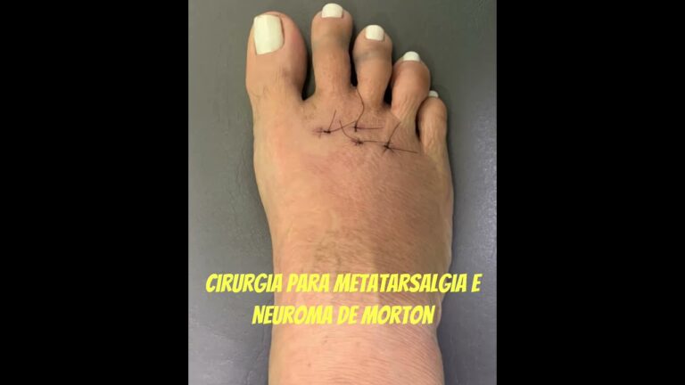 Tratamento Eficaz da Metatarsalgia: Cirurgia como Solu&ccedil;&atilde;o