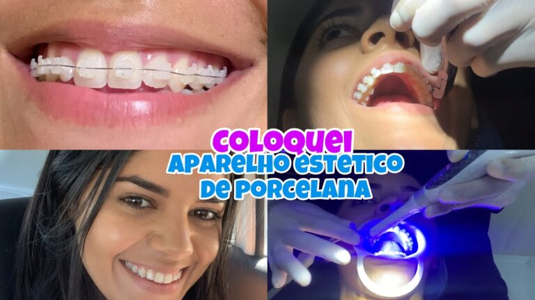 Benef&iacute;cios do Aparelho Dent&aacute;rio de Porcelana