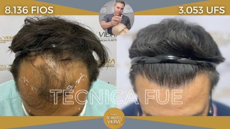 Antes e Depois: Evolu&ccedil;&atilde;o do Implante Capilar M&ecirc;s a M&ecirc;s com Fotos