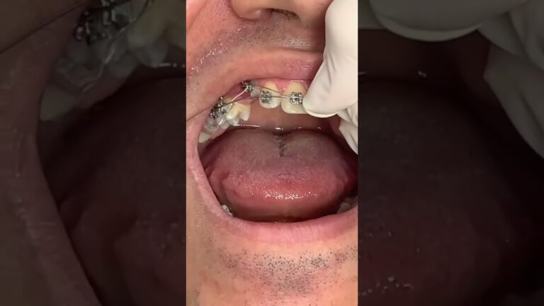Tratamento Eficaz para Dentes Caninos Encavalados