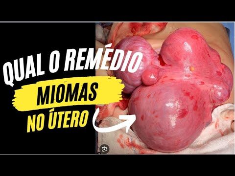 Tratamento Eficaz para Miomas: Qual o Remédio Ideal?