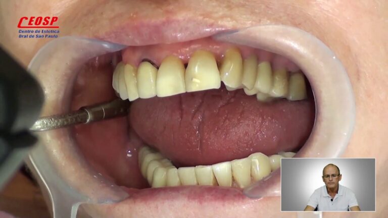 Raiz do Dente Escura: Causas e Tratamentos