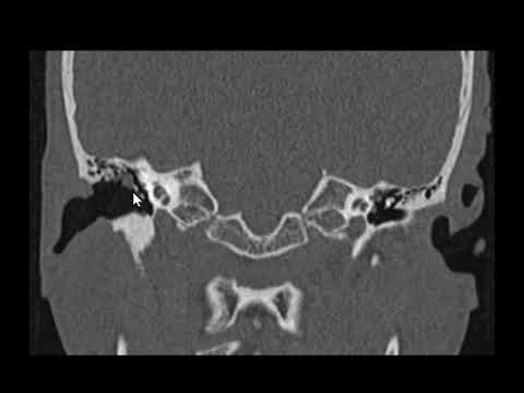 Colesteatoma: Diagnóstico por Tomografia
