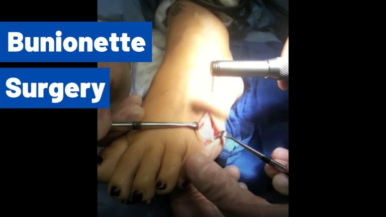 Cirurgia para Bunionette: Soluções e Resultados
