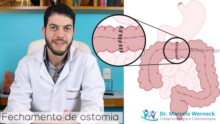 Tempo de Recuperação Após Colectomia: O Que Esperar