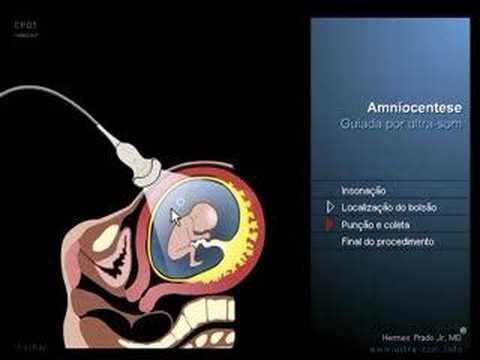 Amniocentese: Entenda o Valor do Exame