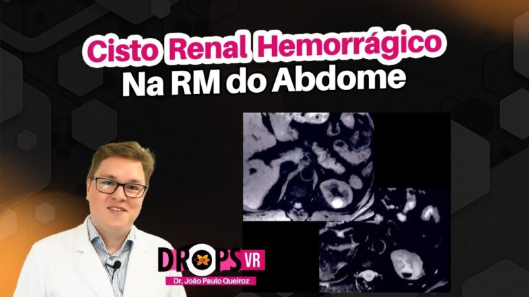 Cisto Hemorrágico no Rim: Causas e Tratamentos