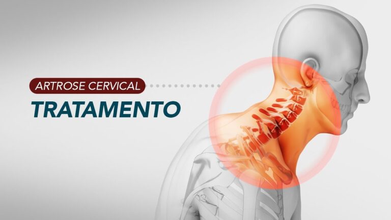 Tratamento Eficaz para Artrose Cervical